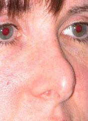 Revision Rhinoplasty - Patient 2 - Obl Right - Before Revision Rhinoplasty - Patient 2 - Obl Right - Before